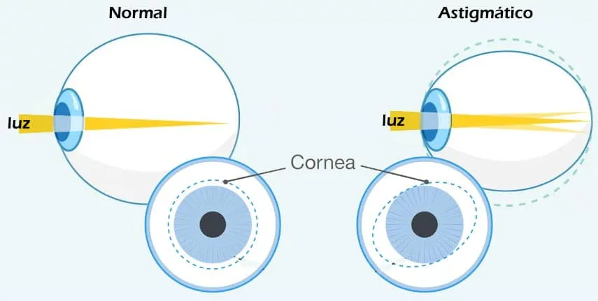 Córnea con y sin astigmatismo